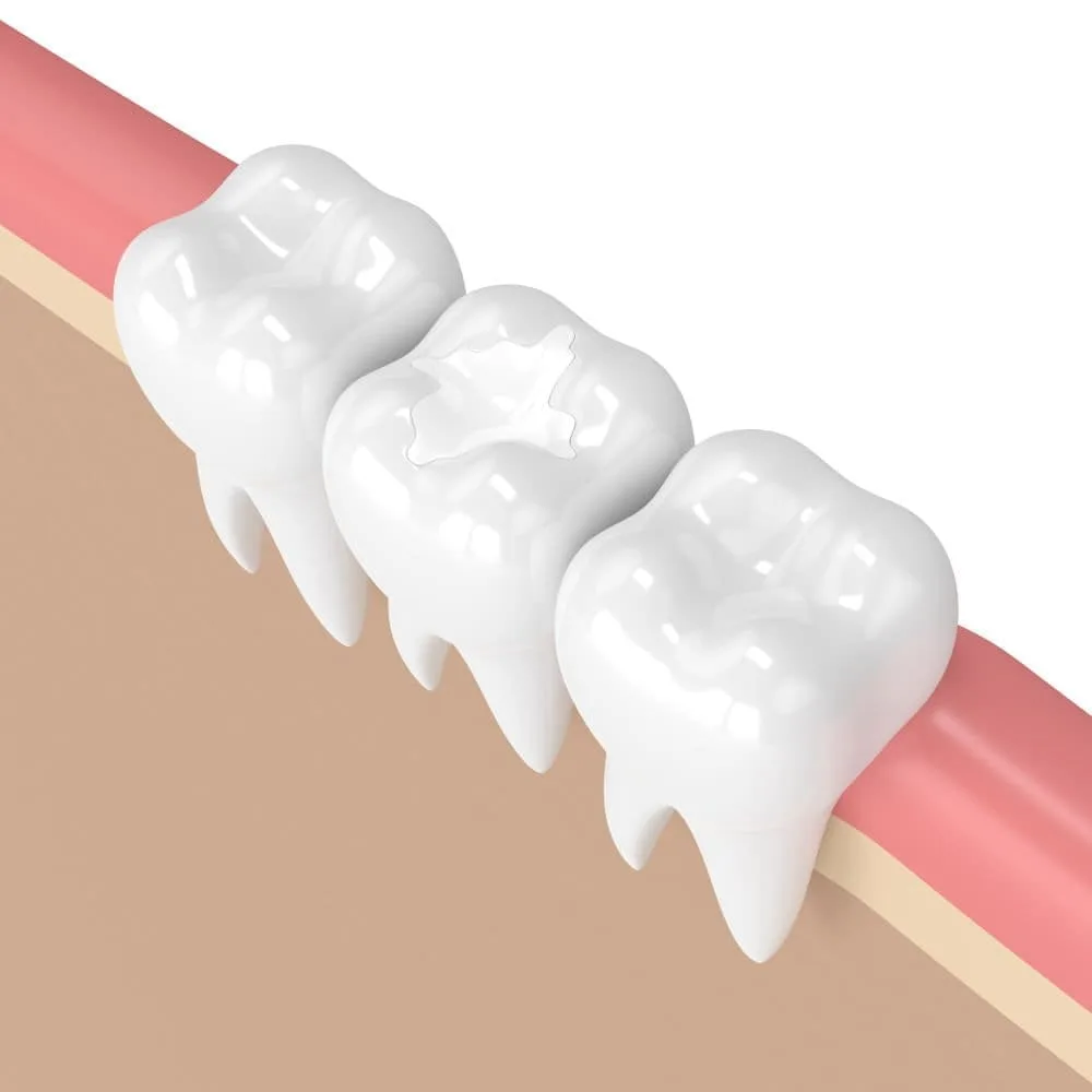 Dental bonding and white filling services at Unique Dental of Framingham.