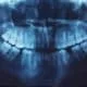 Patient's Dental X-Ray at Unique Dental of Framingham - Unique Dental of Framingham An oral dental X-ray of a patient displayed at Unique Dental of Framingham, Massachusetts.
